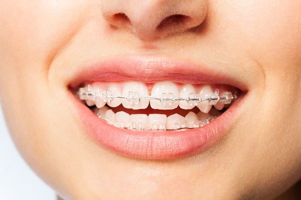 Clear Braces: What Foods Should You Avoid?